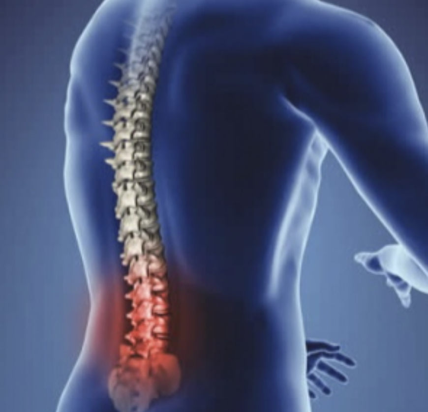 Lumbar Spondylosis